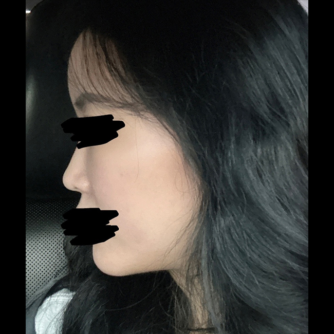 지방흡입이랑 지방이식한 후기입니당~