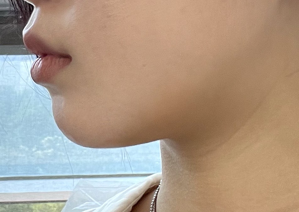 이중턱흡입 턱필러 꿀조합인듯