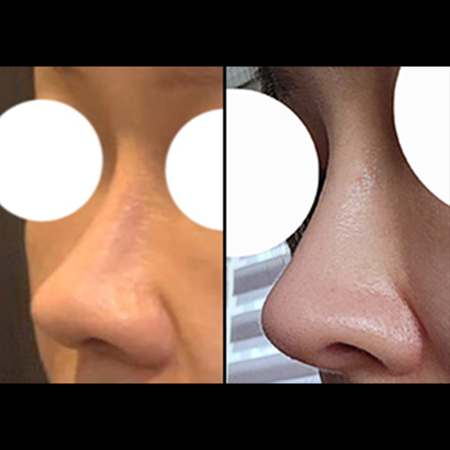 코3번째수술 성공후기:)