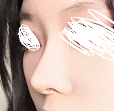 코수술3달차, 이쁘게 자리잡아 가는 중ㅎㅎ