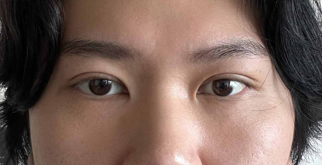 절개눈매교정하고 눈밑지방재배치까지 함께 받았습니다