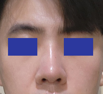 기능코+미용코성형 4개월차됐습니다