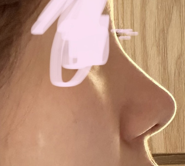 유영문원장님께 코수술받길 잘한듯!