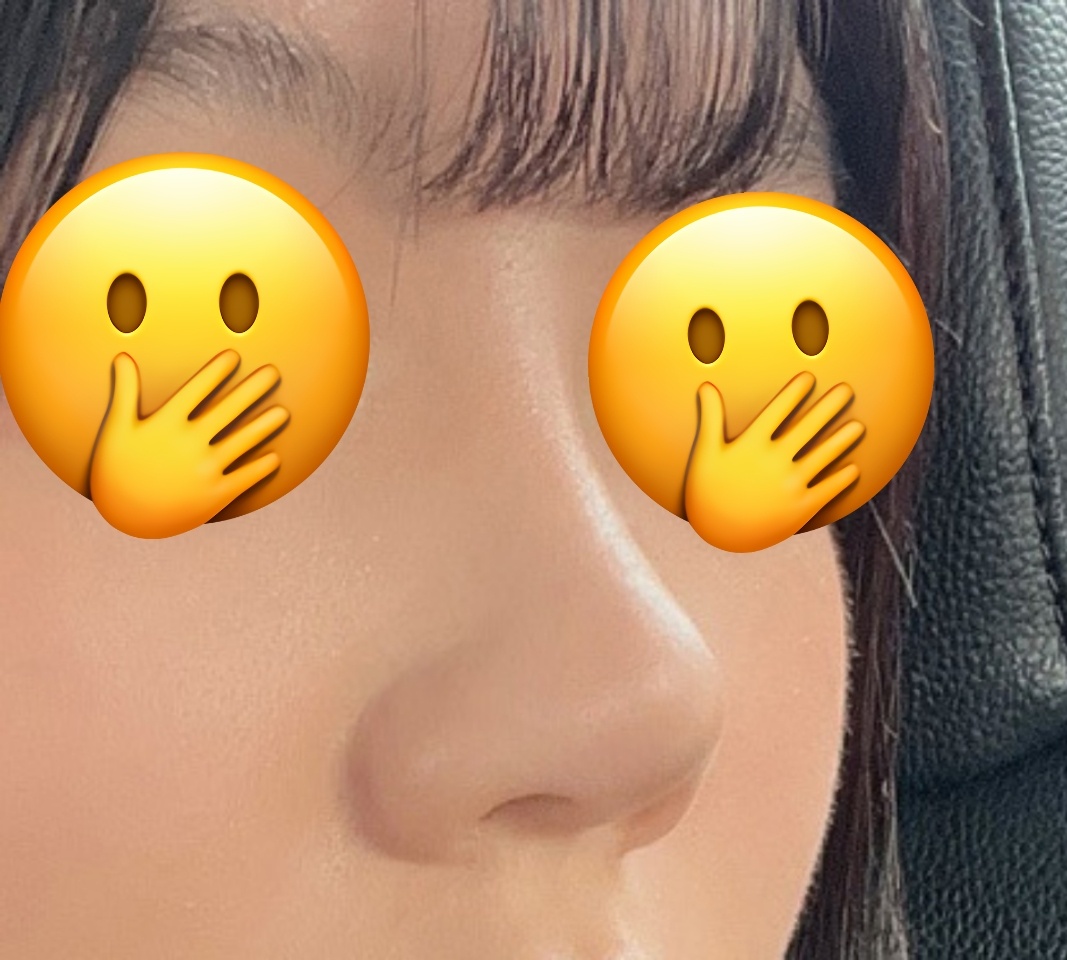 코재수술 6개월차됐어용!!