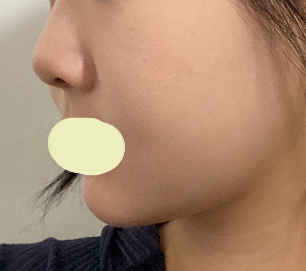 달덩이었던 얼굴, 이제 아니에요 ㅎㅎ