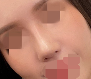 3번째 코재수술이에요