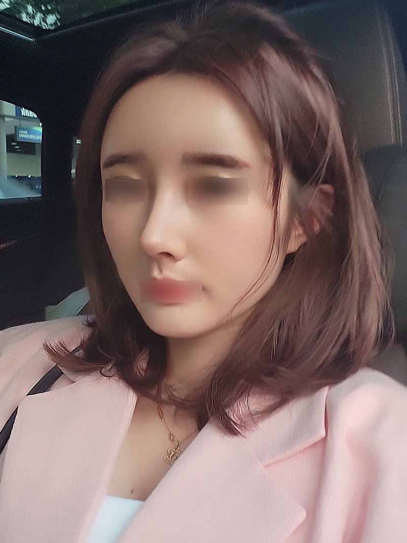 코성형 지방이식 했어요