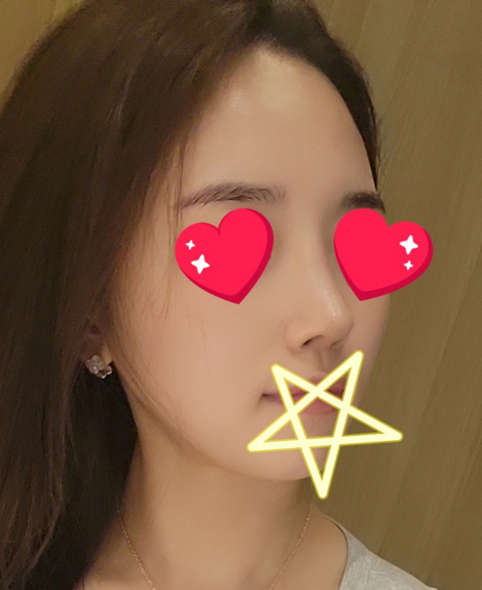 코재수술 잘됐슴당