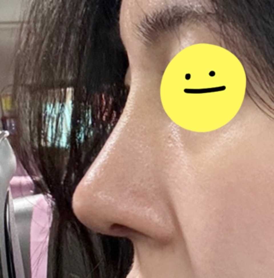 유원장님이 코수술 잘하신다하여 수술했어용!
