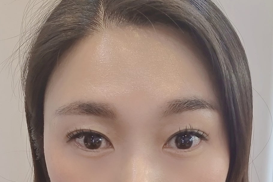 내시경이마거상, 매몰 6개월차 솔직 후기