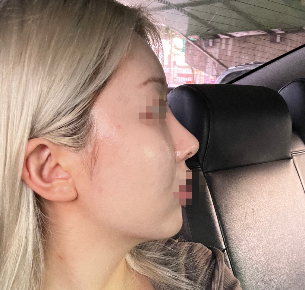 눈재수술,코,지방이식후기! 조화롭게 잘됐슴당