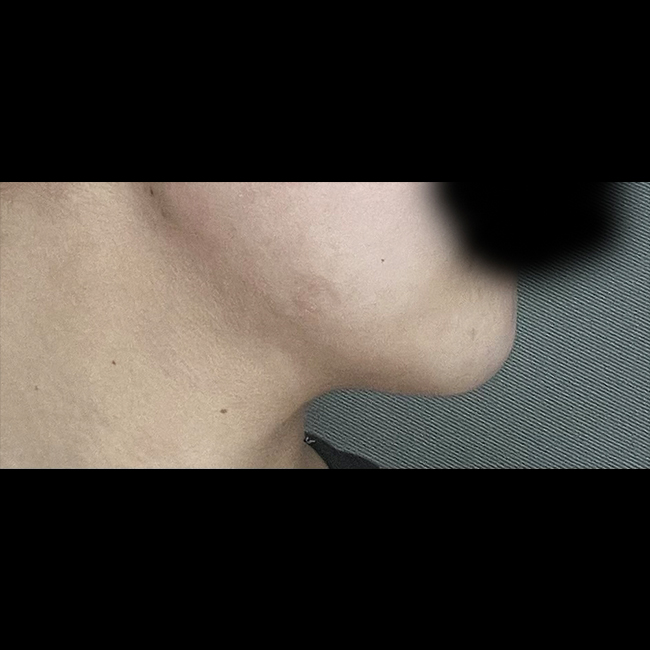 얼지흡 후 턱선 날렵해졌어요