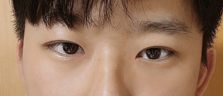 (남자) 비절개눈매교정 + 앞트임 했습니다