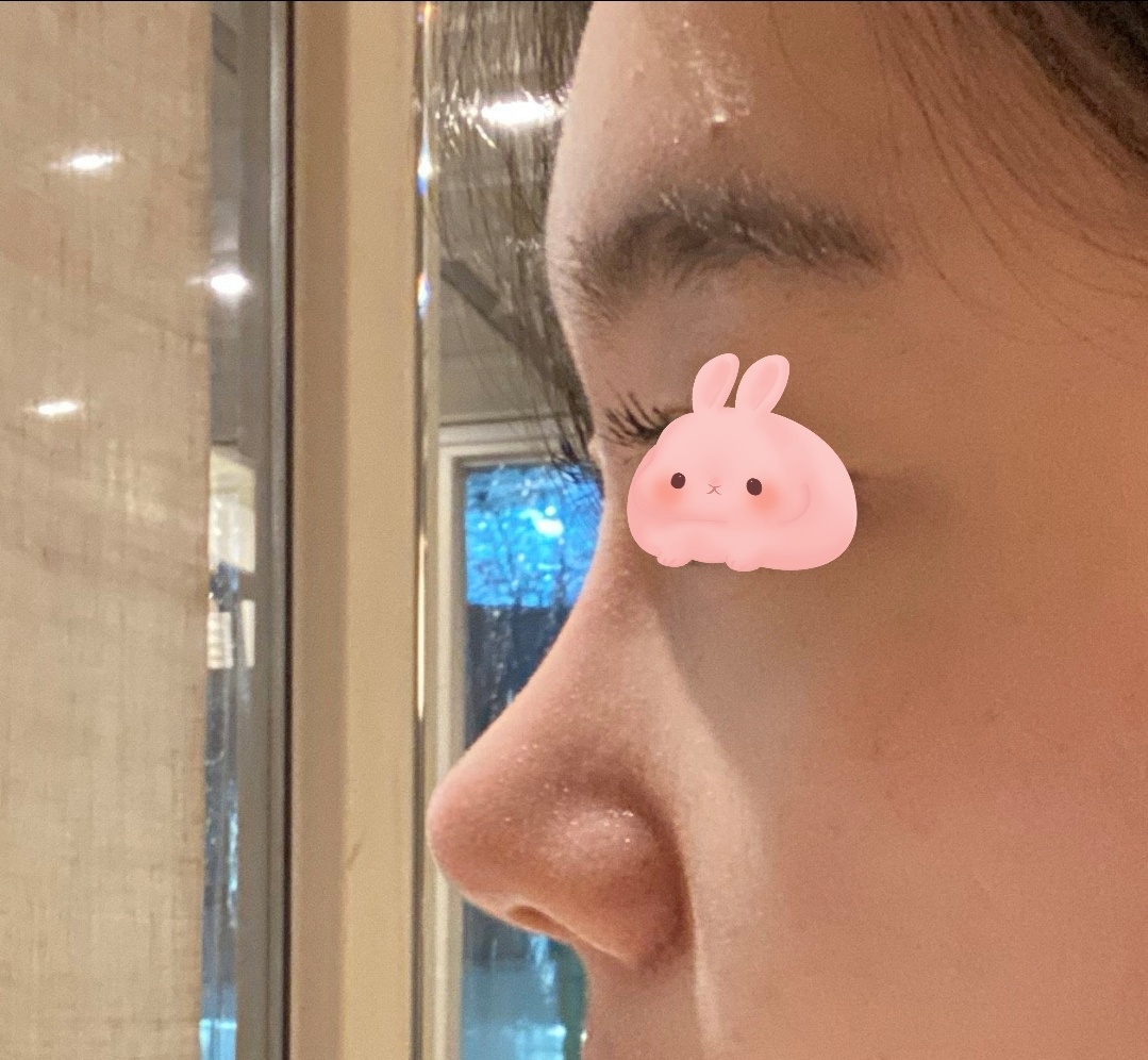 코수술 2개월차 찐후기!!