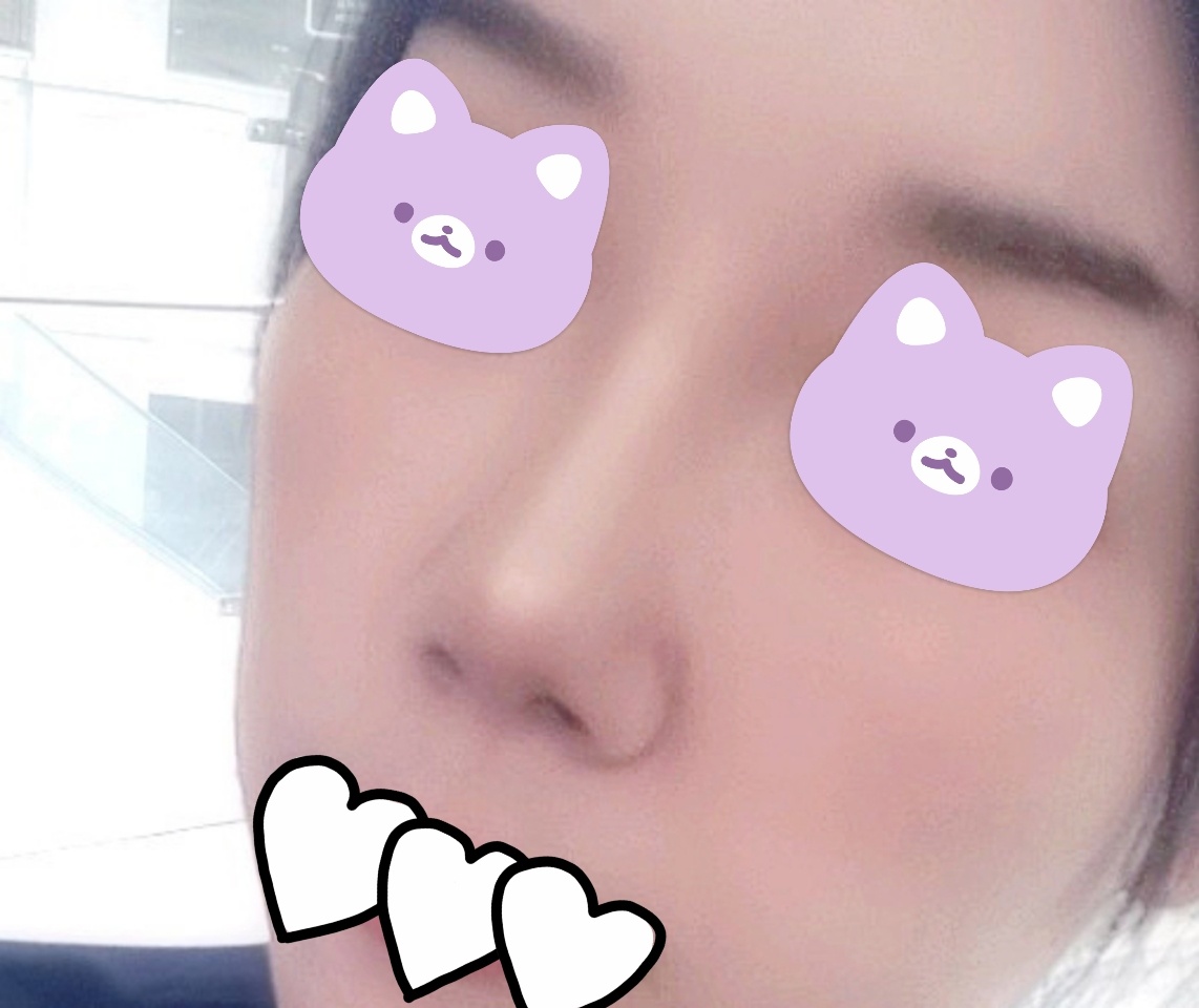 하안검, 코재수술 바이브에서 했습니다^^