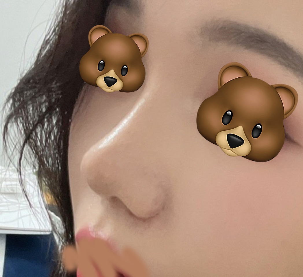 눈재수술+내시경이마거상+코 3개월 후기