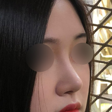 눈재수술, 복코교정 너무 잘됐어요ㅎㅎ