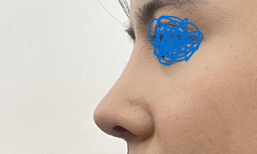 눈매교정3번째재수술+코성형후기^0^