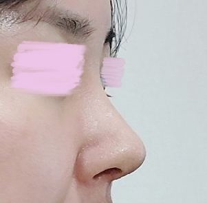 비염도 많이 좋아지고 모양도 예뻐요!