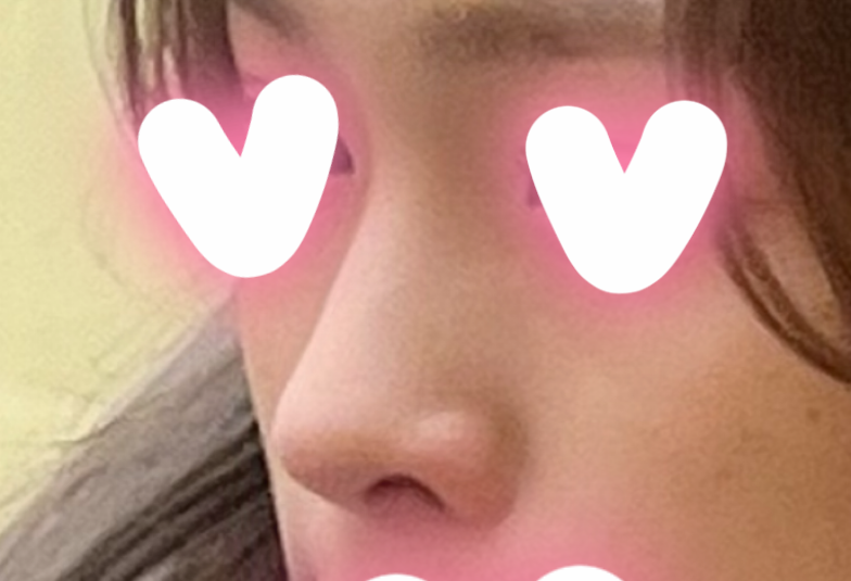 무보형물코수술 바이브에서 한지 4개월차