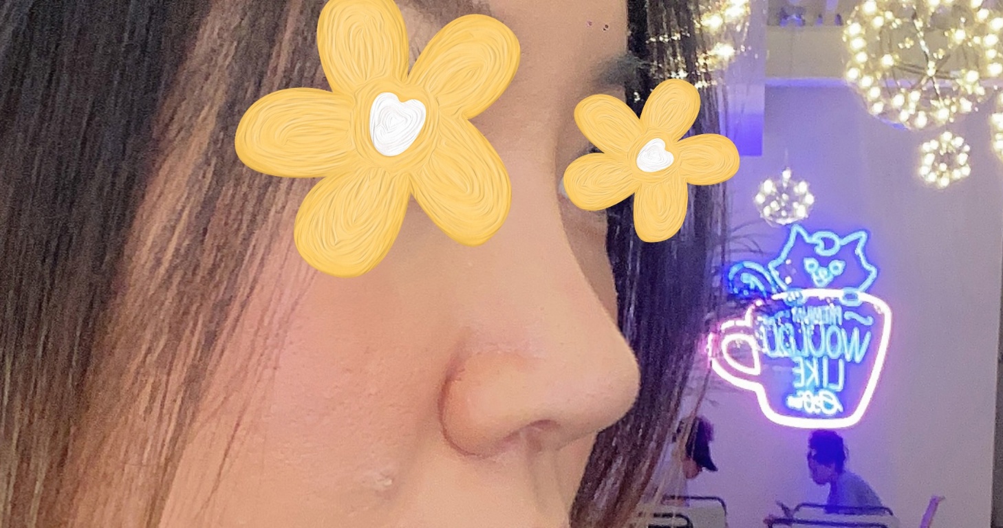 유원장님께 눈, 코수술 받은지 3개월차~~~!!