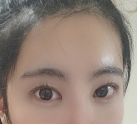 원장님수술스킬 짱짱 ㅎㅎ이마거상, 눈성형 만족후기