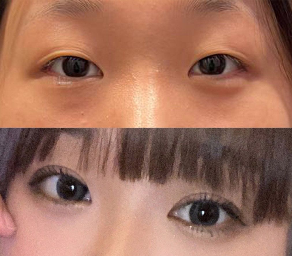 부분절개 4개월됐슴당