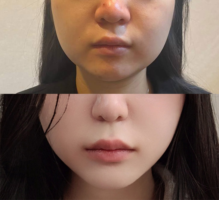수술전후_정면_.jpg