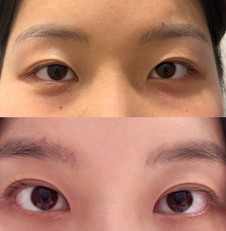 눈이 또렷해지고 짝눈도 교정됐어요!