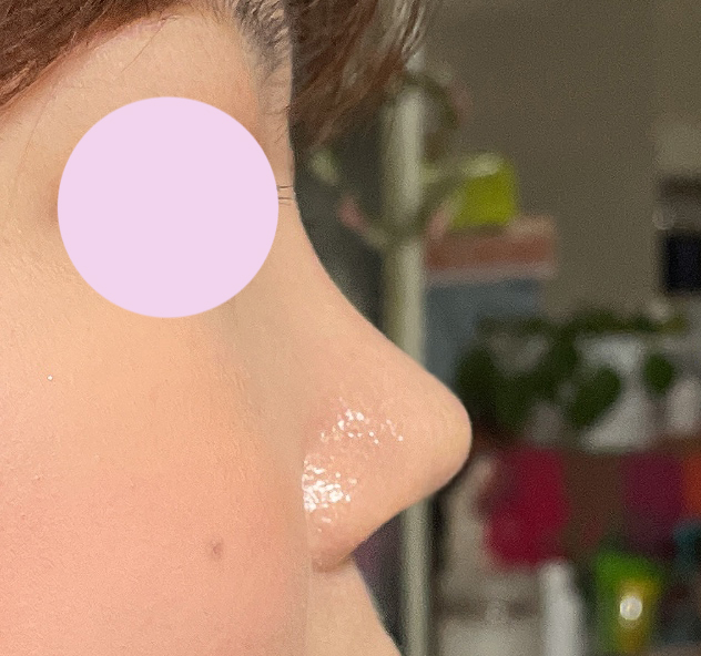 코, 얼굴지흡2개월차인데 아주 만족합니다~