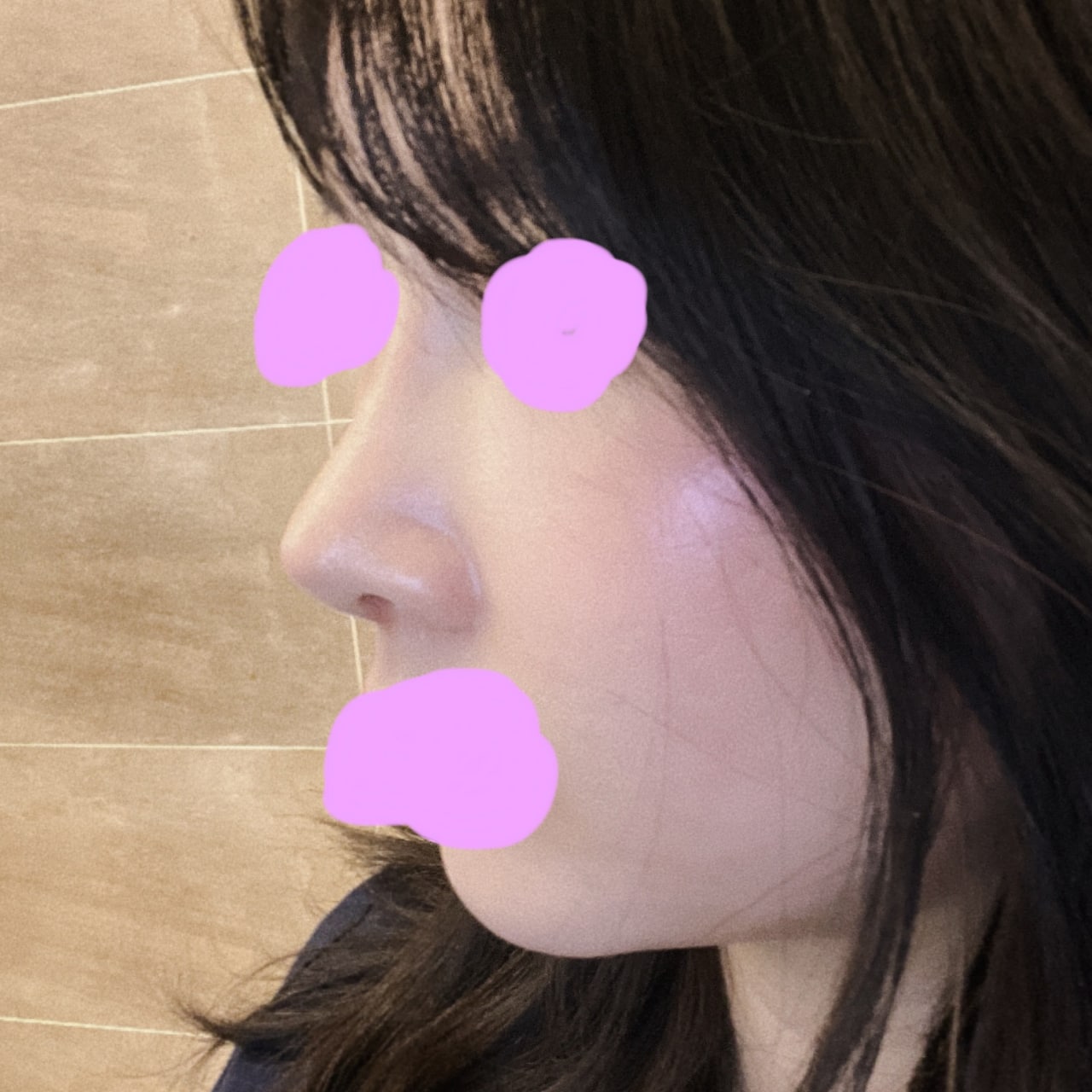 더할나위없이 만족스러운 수술이었어요