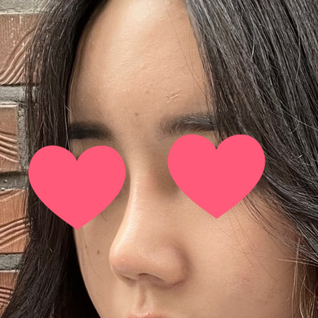 엄청 예쁜 코 됐어요ㅠㅠ