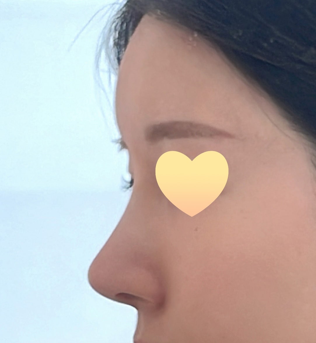 무보형물 코재수술 성공^^