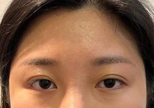 수술전_1_눈,_이마.jpg