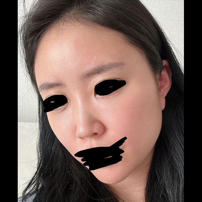 수술후_3_.jpg