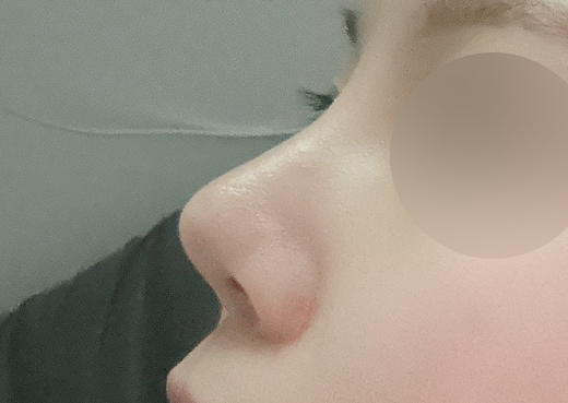 짧은코수술받은지 5개월넘음요~