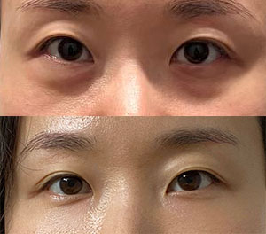눈밑성형 잘됐죠^^?