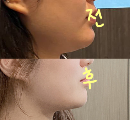 수술전후측면.jpg