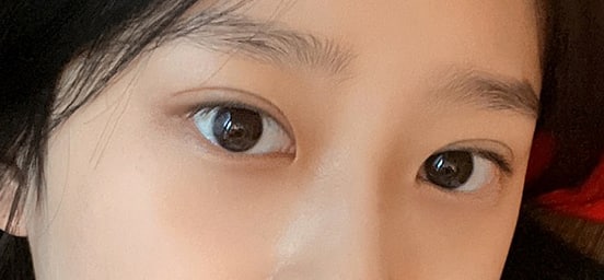 눈 수술 성공적이에요 ㅠㅠㅋㅋ