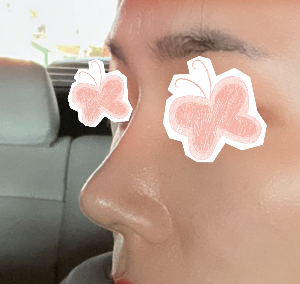 코성형잘됐죵??3개월차후기입니다~~