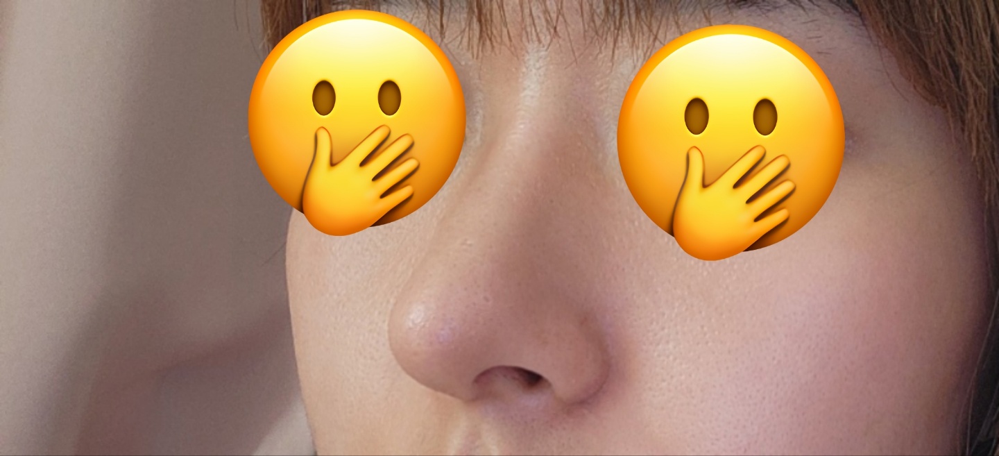 매부리코성형, 비절개눈매교정 2달됐어요