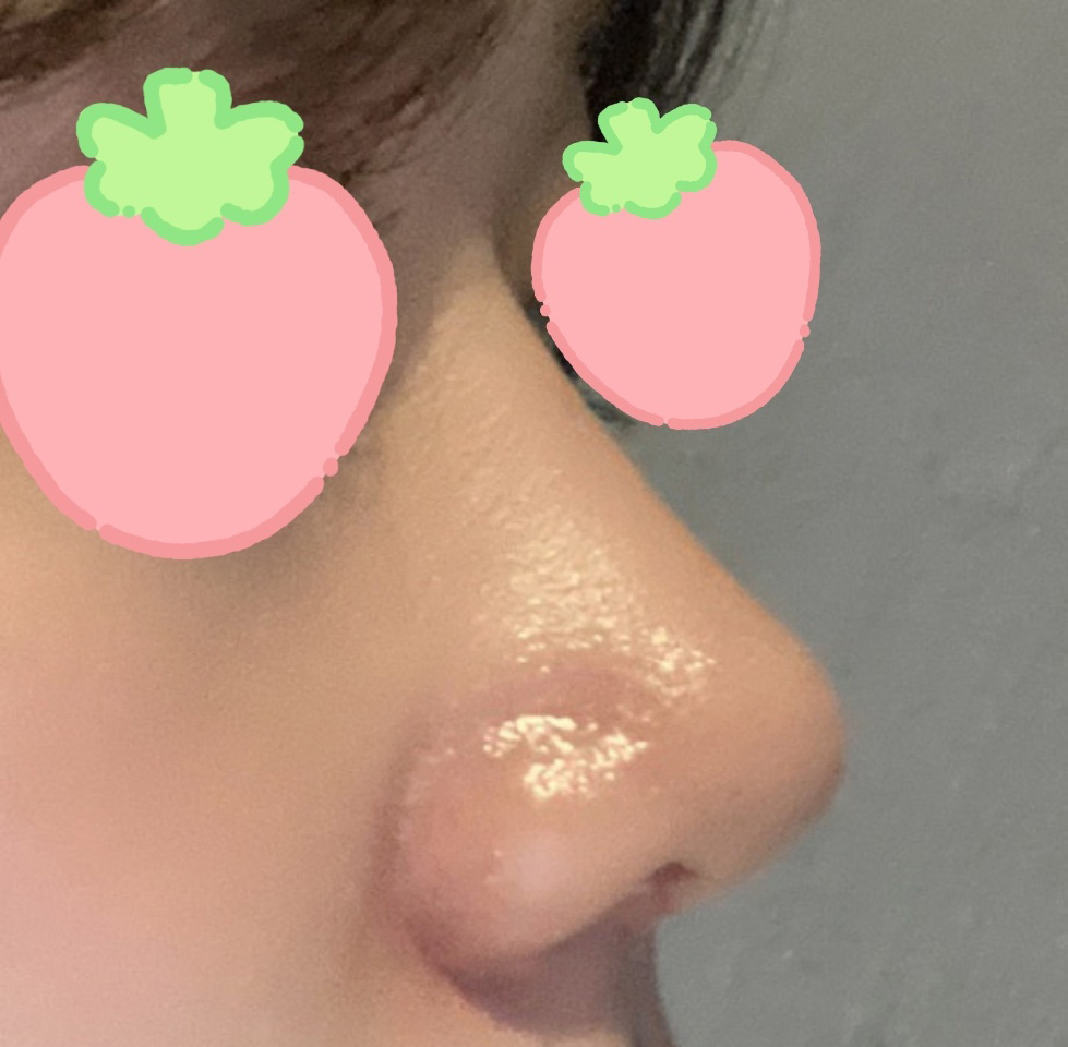 매부리코+복코수술 2개월됐습니다~~