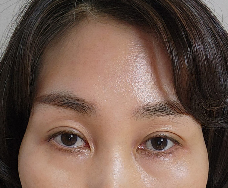 내시경이마거상, 비절개눈매교정 마음에 들어요~