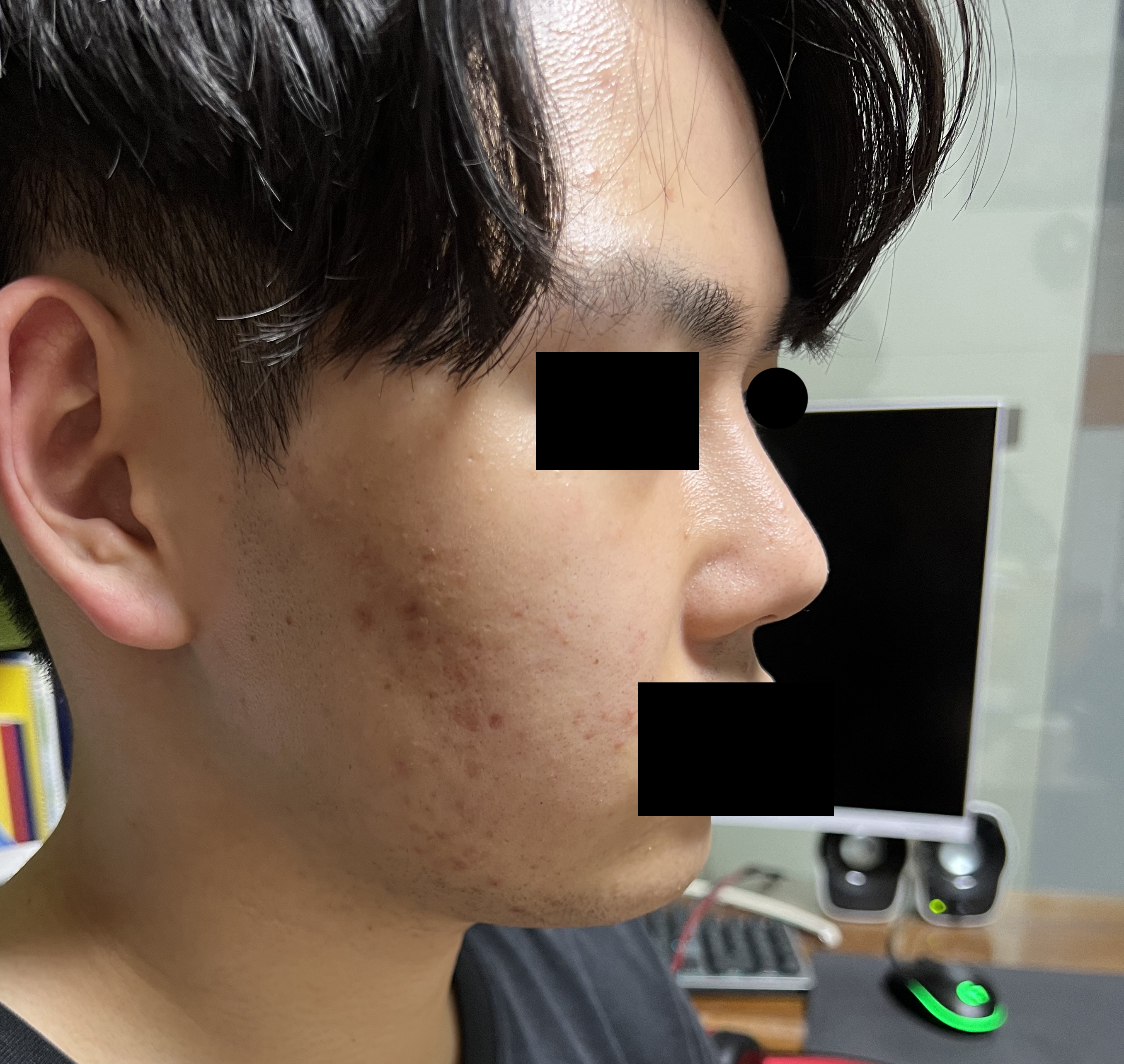 눈, 코, 무턱성형 5개윌지났습니다!