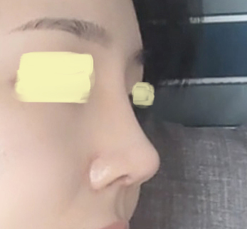 코성형 후기! 맘에 들어서 좀 길게 썼어요:)