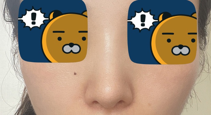매부리코수술6갤차, 후회1도없음!