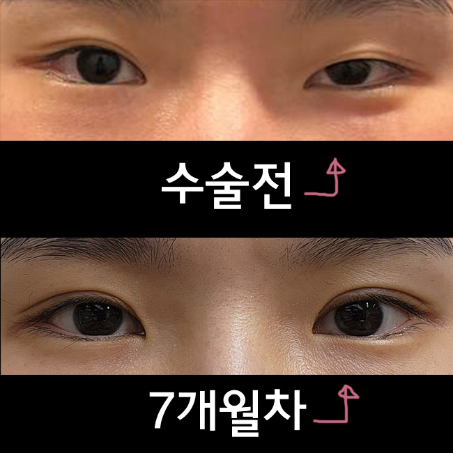 수술전후.jpg