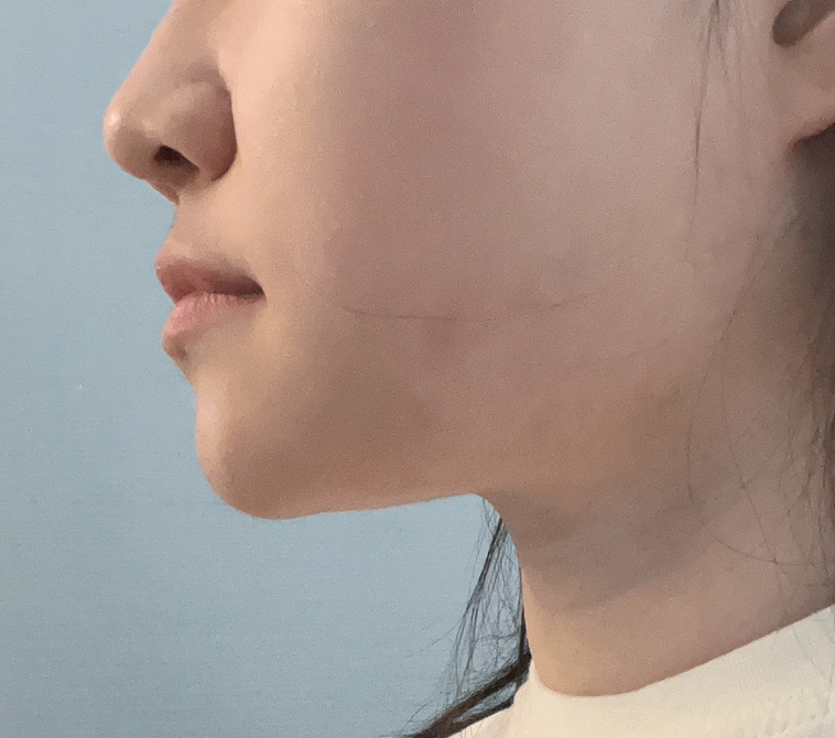 얼굴지방흡입 10000%이상 만족~~