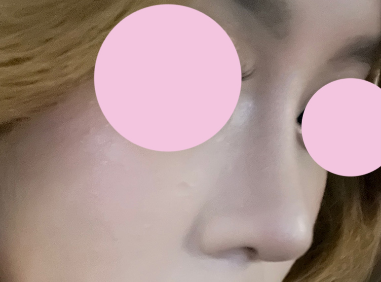 코성형 만족스러워요!