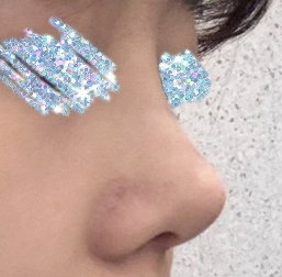 작고 짧은 코, 오똑하게 성공><